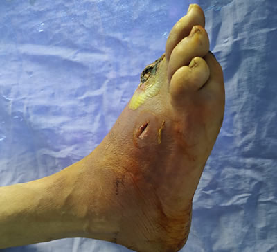 Tratamiento para pie diabético